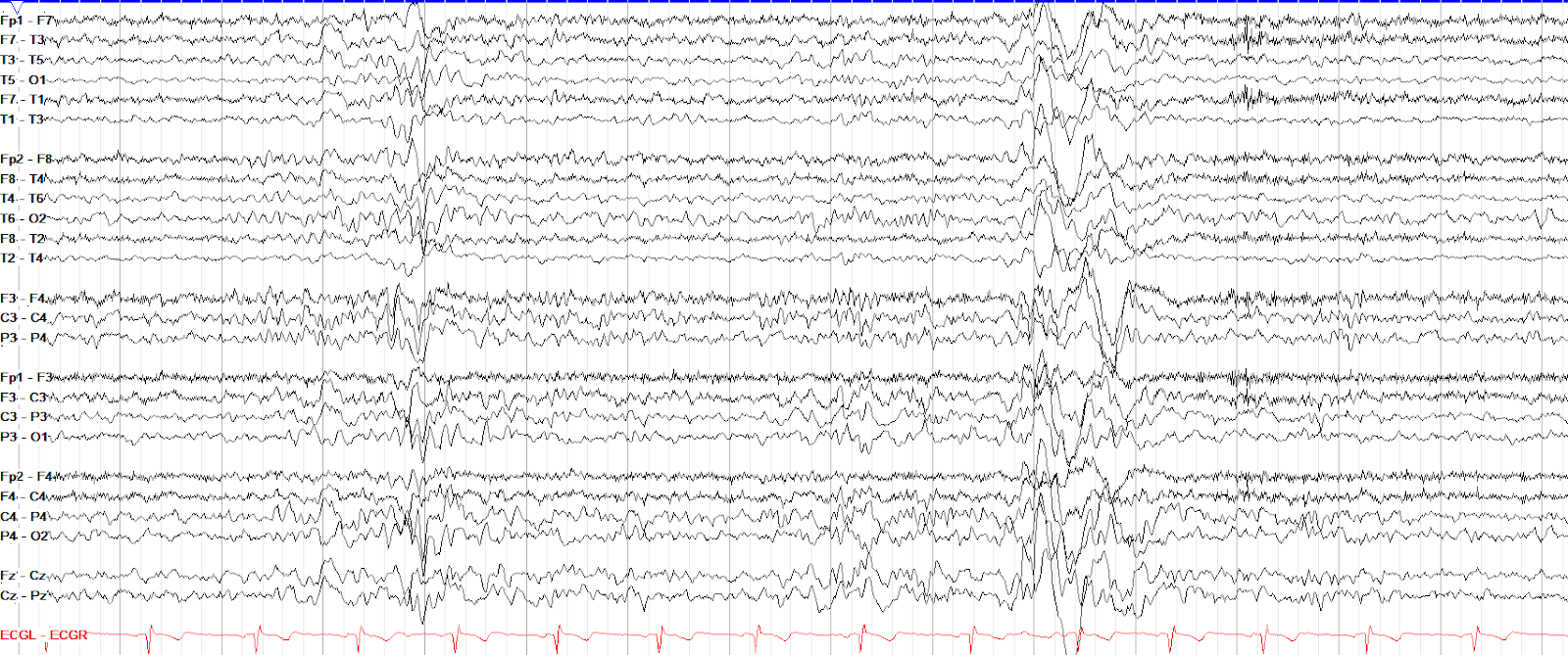 High amplitude K complexes